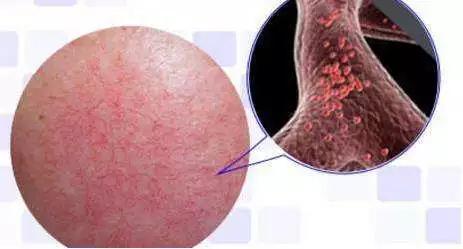 这5个方法让你轻松搞定红血丝,潮红性红血丝怎么修复