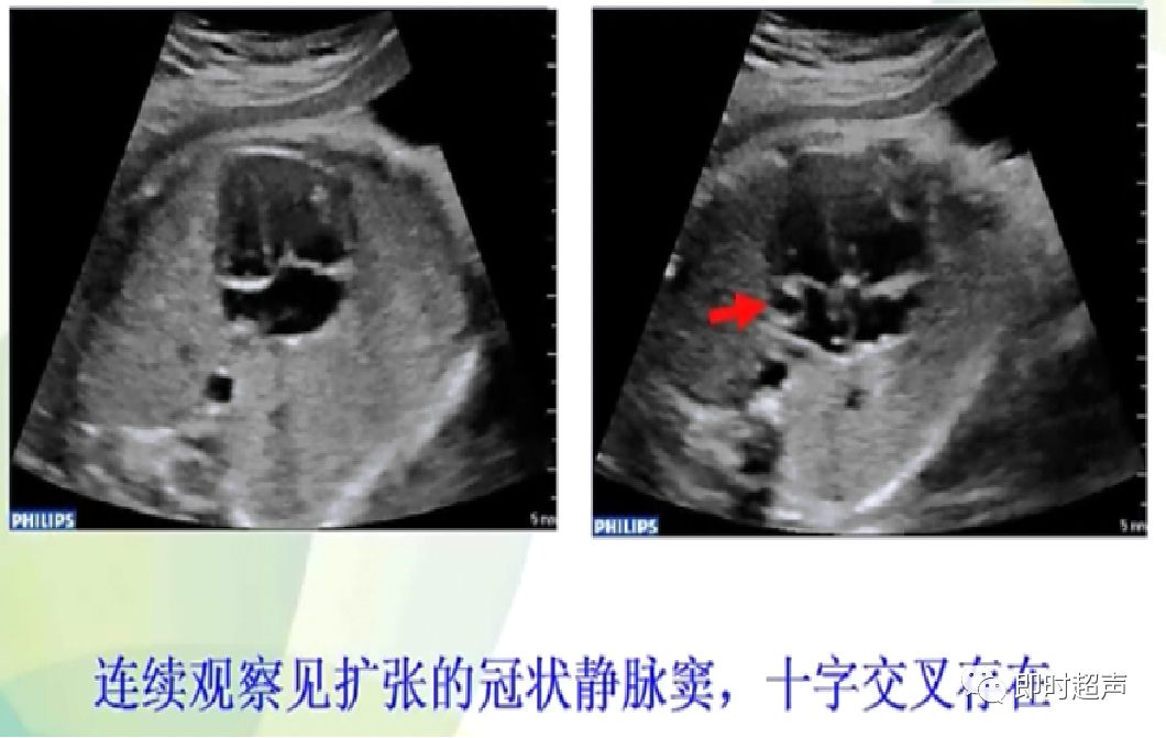 胎儿心脏三种血管关系模式图,25周的胎儿心脏弓切面多少正常