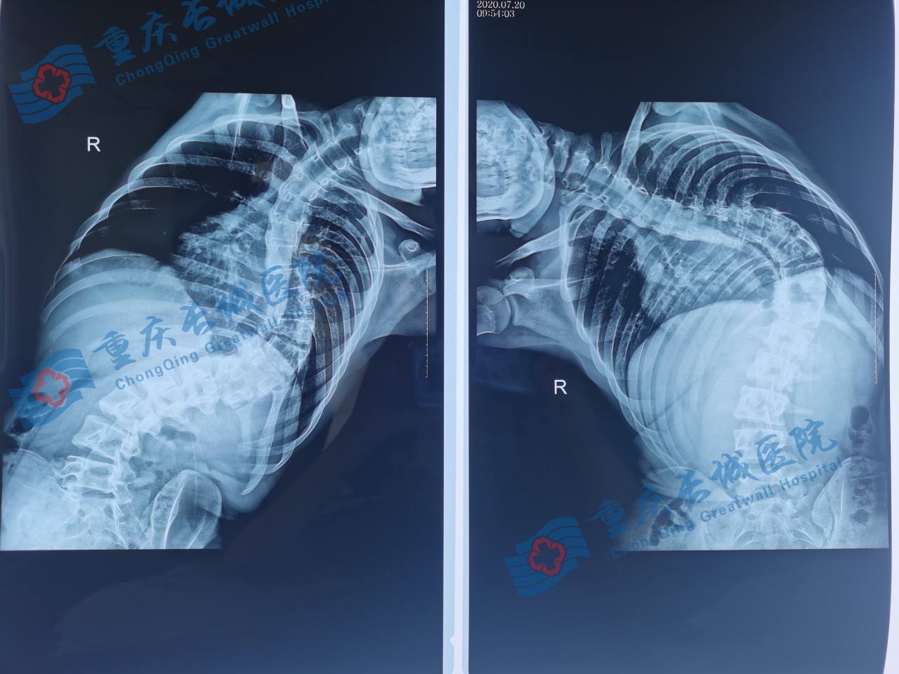 关爱脊柱健康儿童脊柱侧弯,关注脊柱侧弯让孩子少走弯路