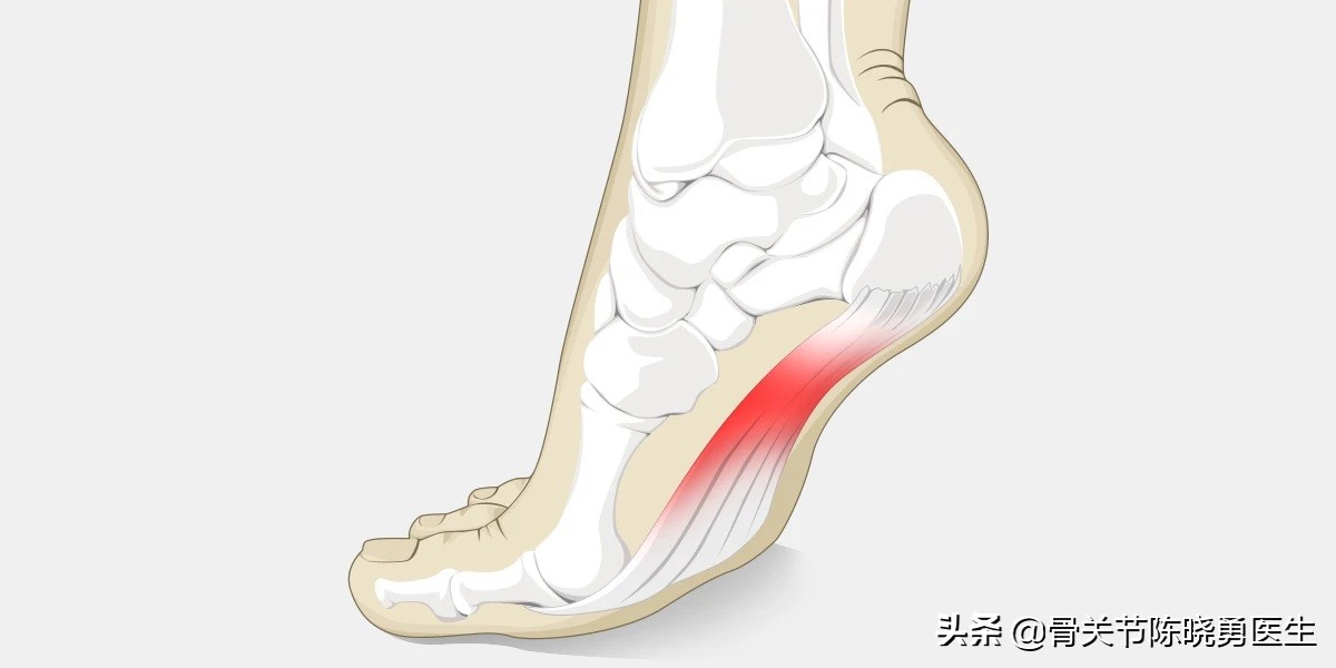 足弓跟腱疼痛什么原因,脚底足弓疼痛怎么回事