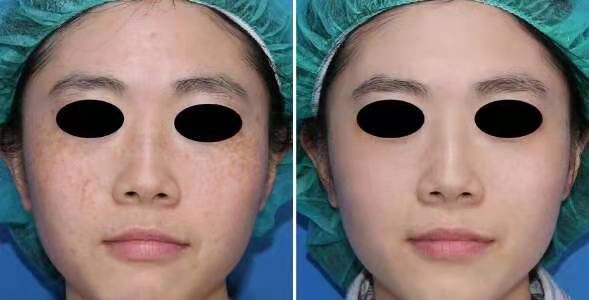 光子祛斑有一道一道的印子,光子祛斑和皮秒哪个更彻底