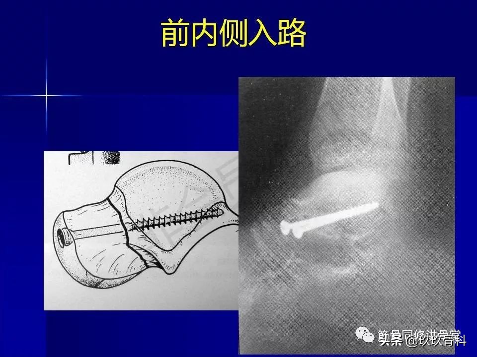 距骨骨折的治疗原则,距骨骨折如何调理