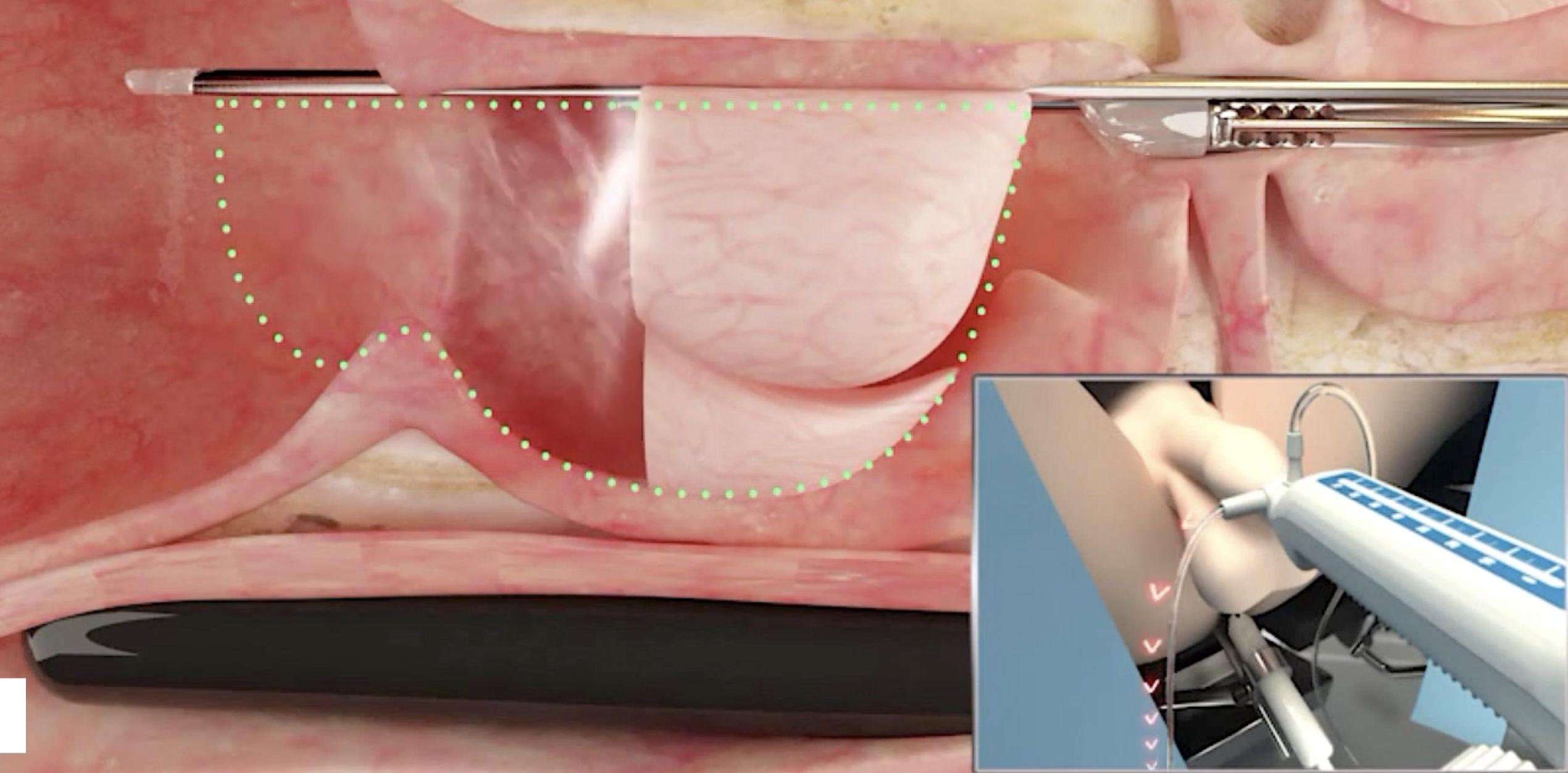 治疗前列腺增生什么方法最靠谱,前列腺增生何种方式治疗效果最好