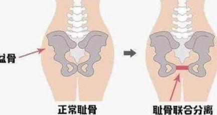 最让孕妈难捱的痛叫“耻骨痛”，这5种孕妇要留意，简直疼得要命