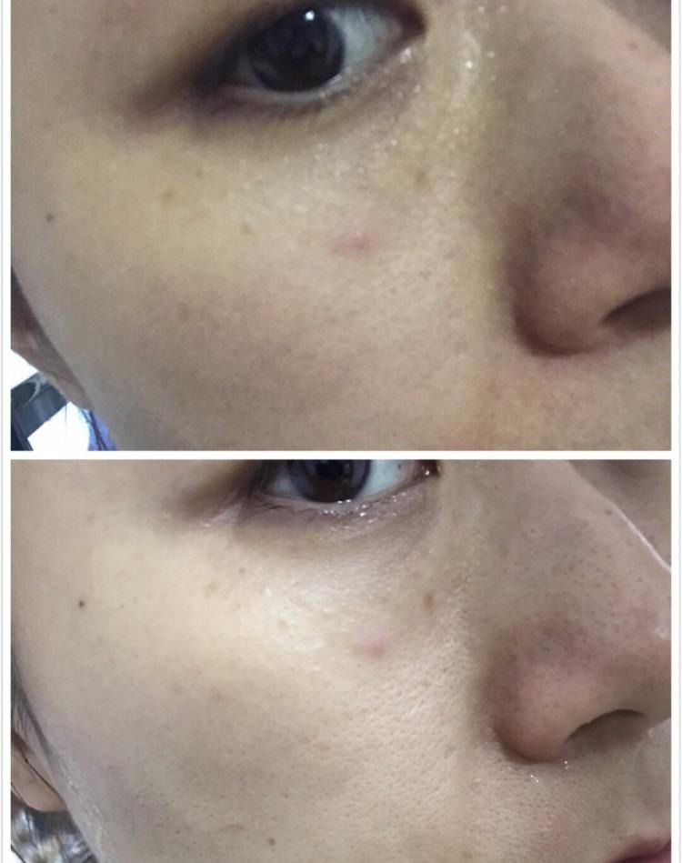 如何有效的去角质,去角质方法长期不去角质会怎样