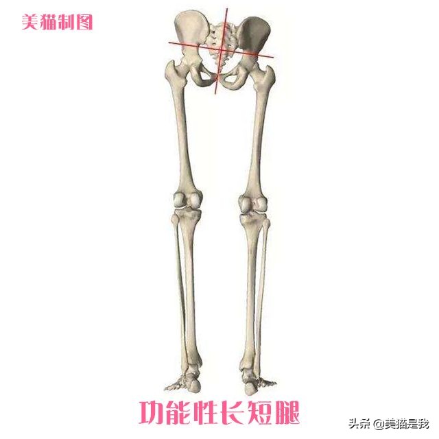 长短腿跟腿型能矫正吗,长短腿矫正锻炼方法左腿长右腿短