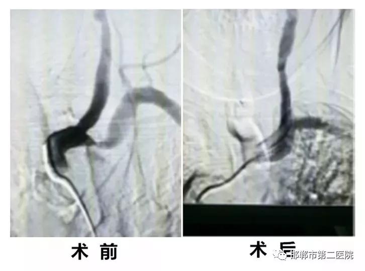 邯郸市第二人民医院介入血管外科,邯郸第二人民医院内五科