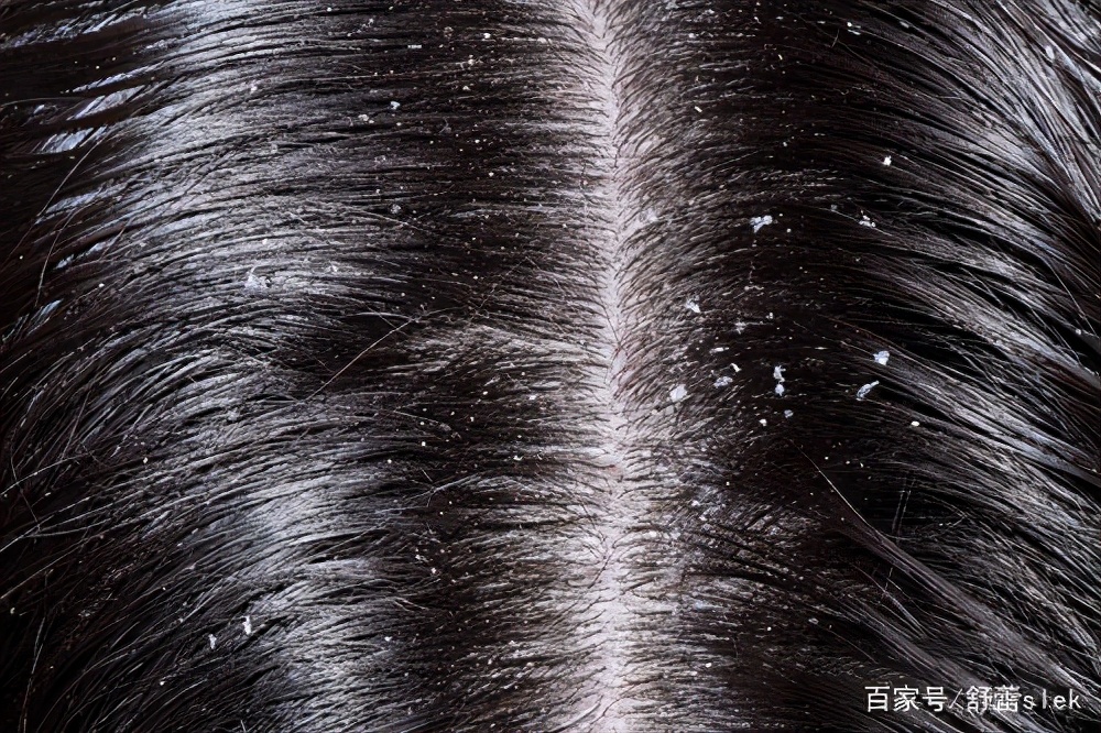 舒蕾去头屑测评,舒蕾洗发水的产品知识