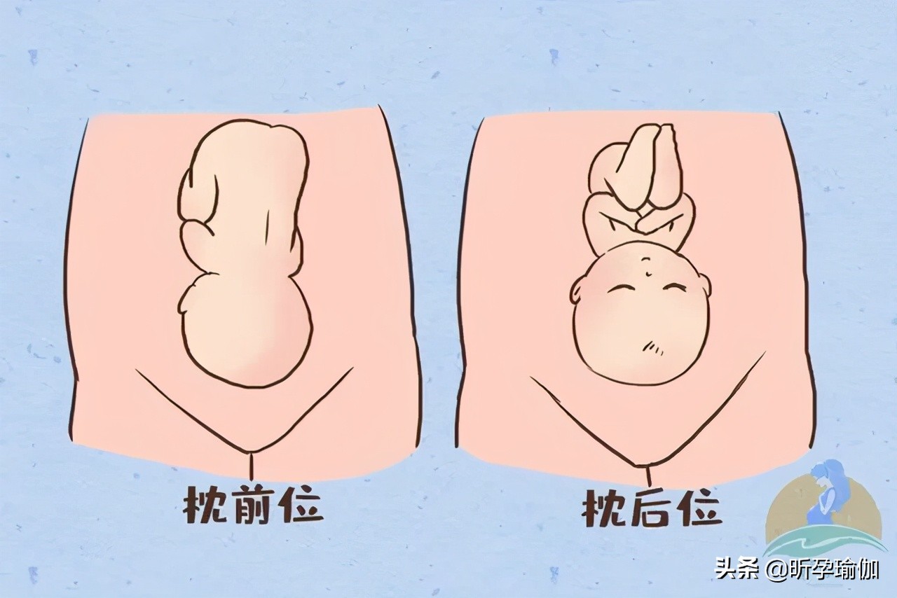 枕后位更痛吗,枕后位容易顺转剖吗