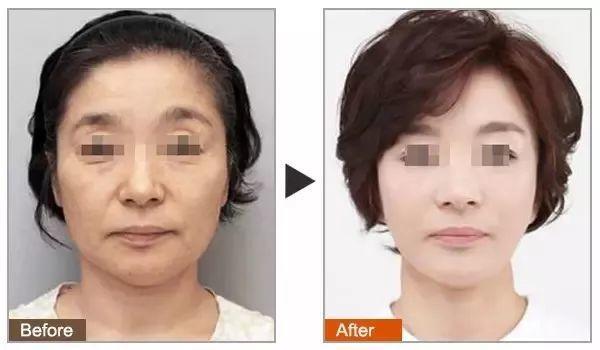 超声刀和热玛吉哪个提升效果好,超声刀和埋线提升哪个效果好