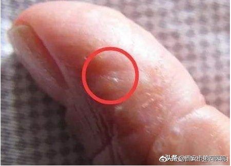 为什么一到夏天手上会长小水泡,夏天手脚长小水泡用什么药