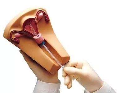 绝经后节育环长肉里怎么取,绝经后节育环不取会引起内膜厚吗