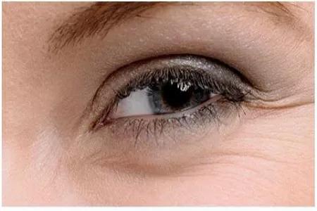 四十岁男人鱼尾纹怎么去除小窍门,生活小妙招去除皱纹