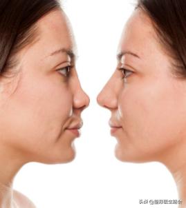 隆鼻手术后鼻子有点歪怎么办,隆鼻鼻子斜歪是怎么回事