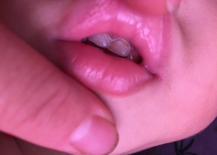 孩子乳牙别扔掉关键时能救命,乳牙千万不要硬拔