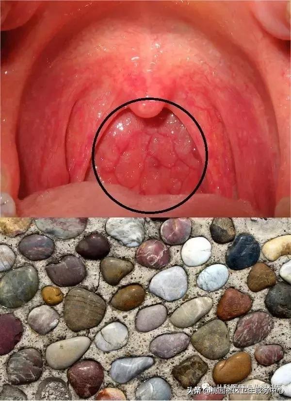 过敏性鼻炎手术的全过程,治疗过敏性鼻炎有效的药