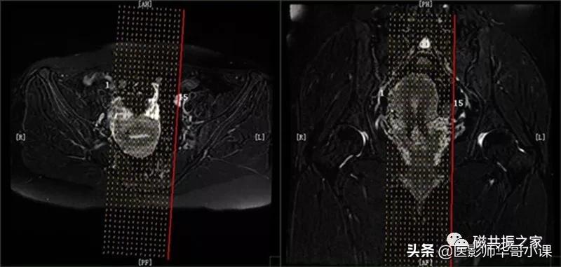 「精品课件」带大家看看，磁共振子宫MRI要如何扫描？