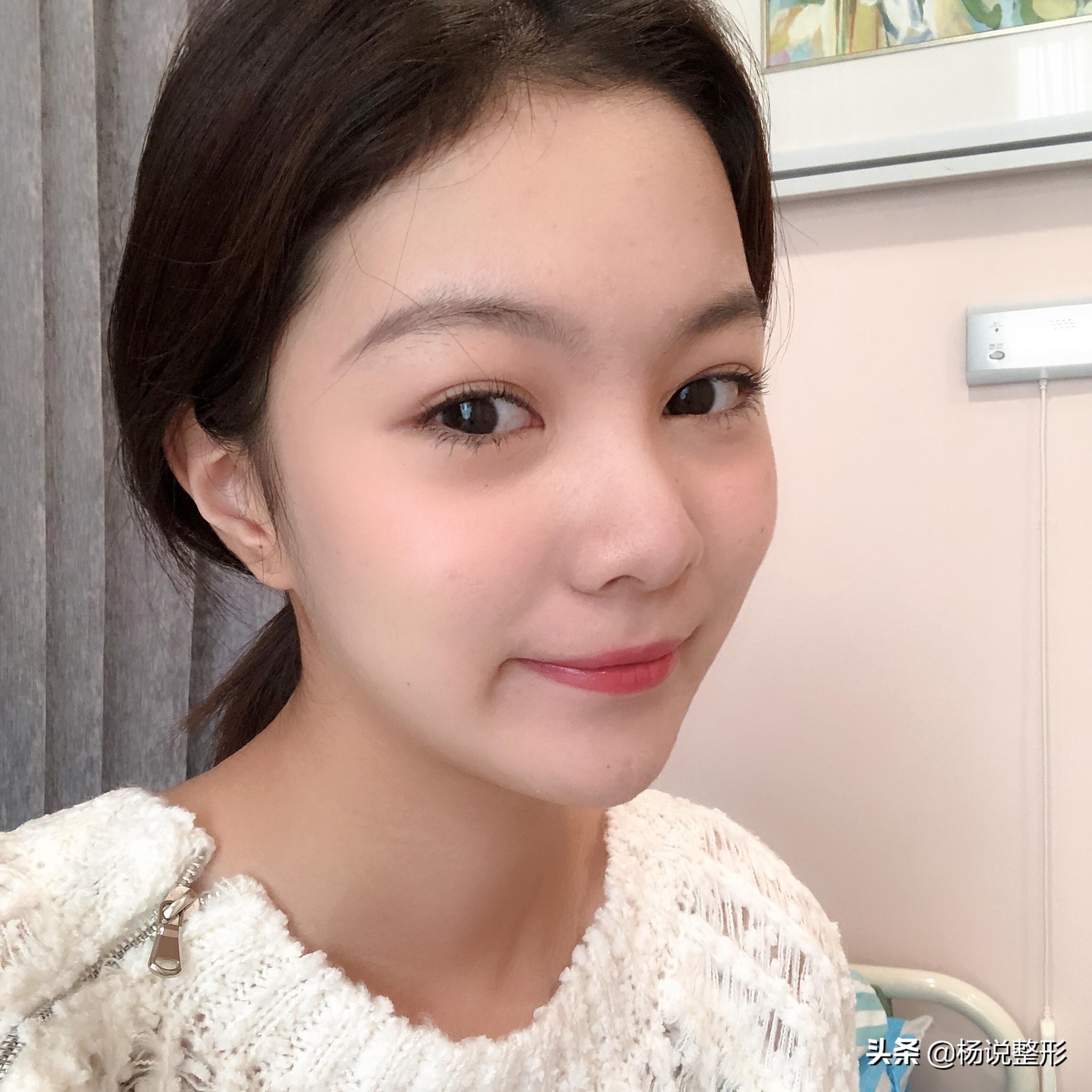 28岁做线雕提升脸部好不好,28岁女人做线雕现状