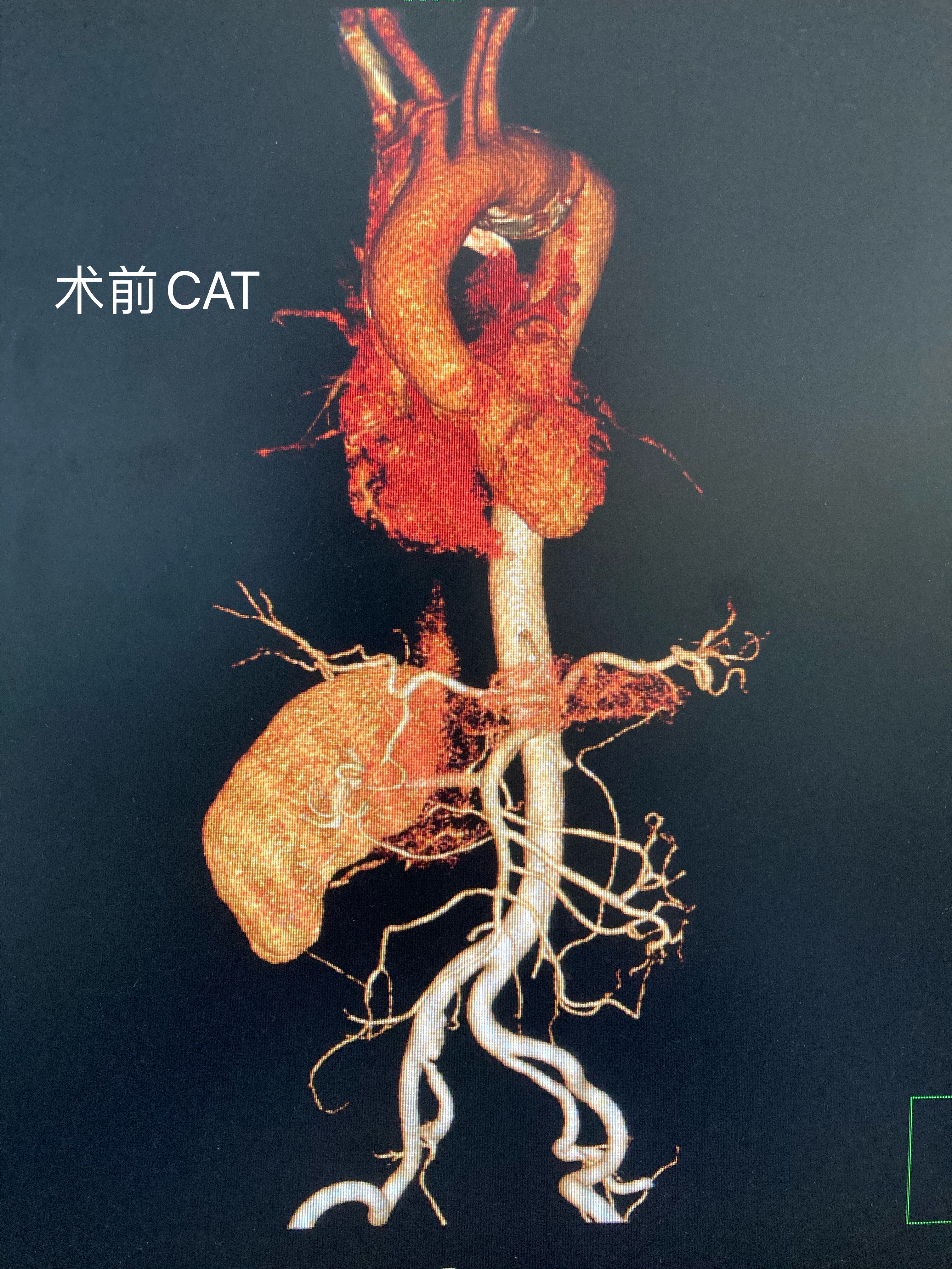 成都市第三人民医院一期工程,成都第三人民医院做心脏支架