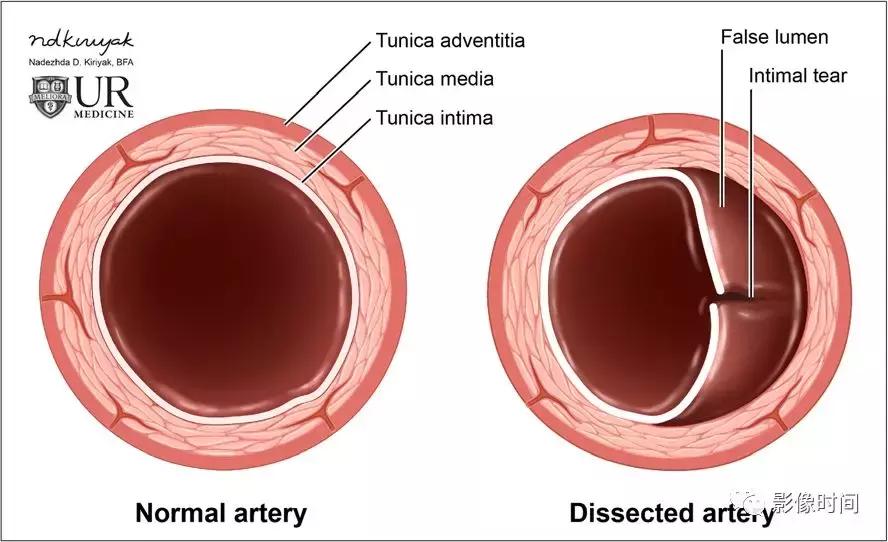 双侧颈动脉鞘间隙多发小淋巴结影,双侧颈动脉间隙多软组织密度结节