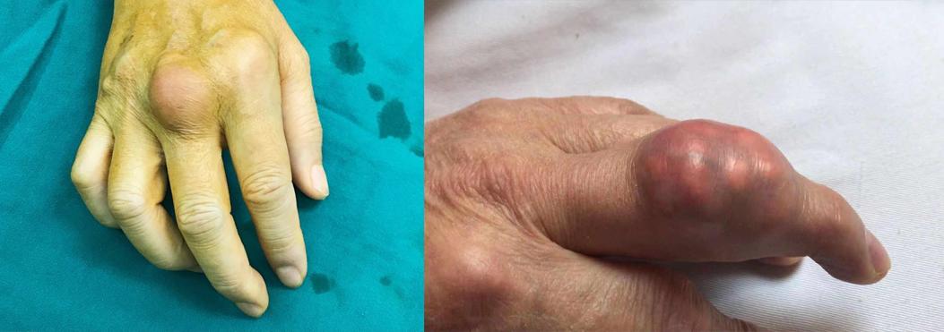 痛风脚踝有痛风石怎样才能变小,痛风石是引起痛风的根本原因吗