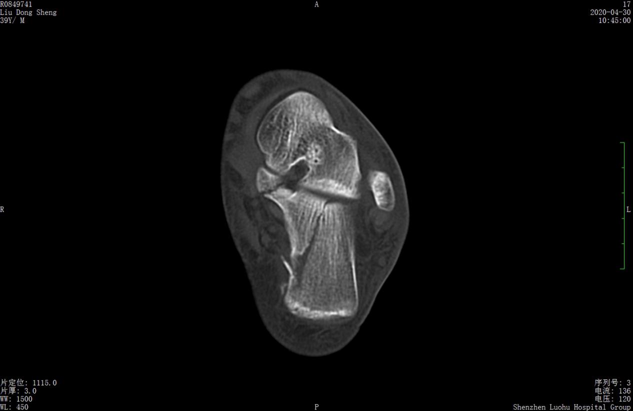 左股骨粗隆间粉碎性骨折微创手术,跟骨粉碎性骨折微创手术最快多久