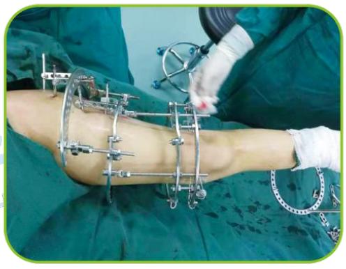 脑卒中中医康复手段,脑卒中的介入手术方法