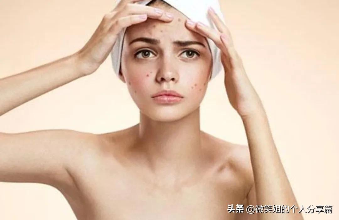 背反复长痘长闭口什么原因,眉间长痘长闭口是什么原因