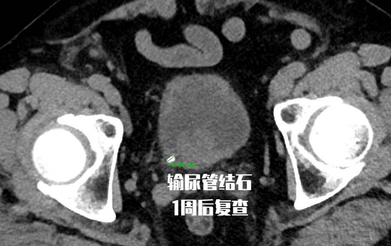 泌尿结石的治疗方法与分类,泌尿系结石的病人