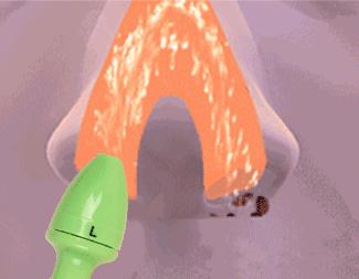 过敏性鼻炎正确冲洗方法,过敏性鼻炎冲洗鼻子正确方法视频