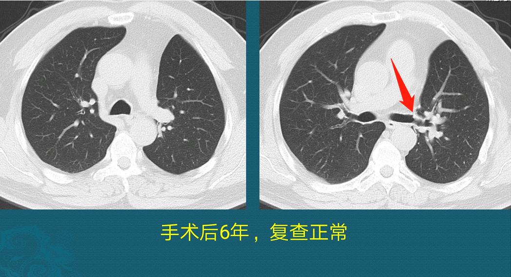 怎样确定肺鳞癌生长速度过快,肺鳞癌肿瘤生长速度