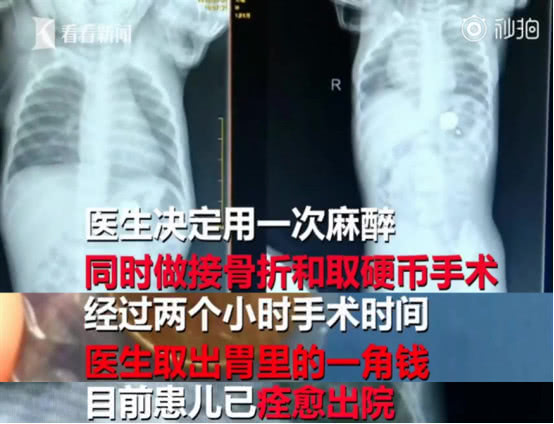 1岁儿子摔伤生命垂危,一岁宝宝摔断胳膊后续