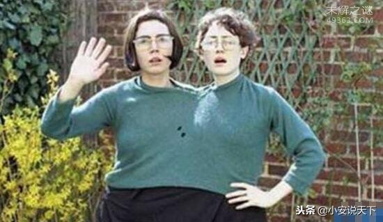 巴西双头婴儿,巴西双头婴儿后续