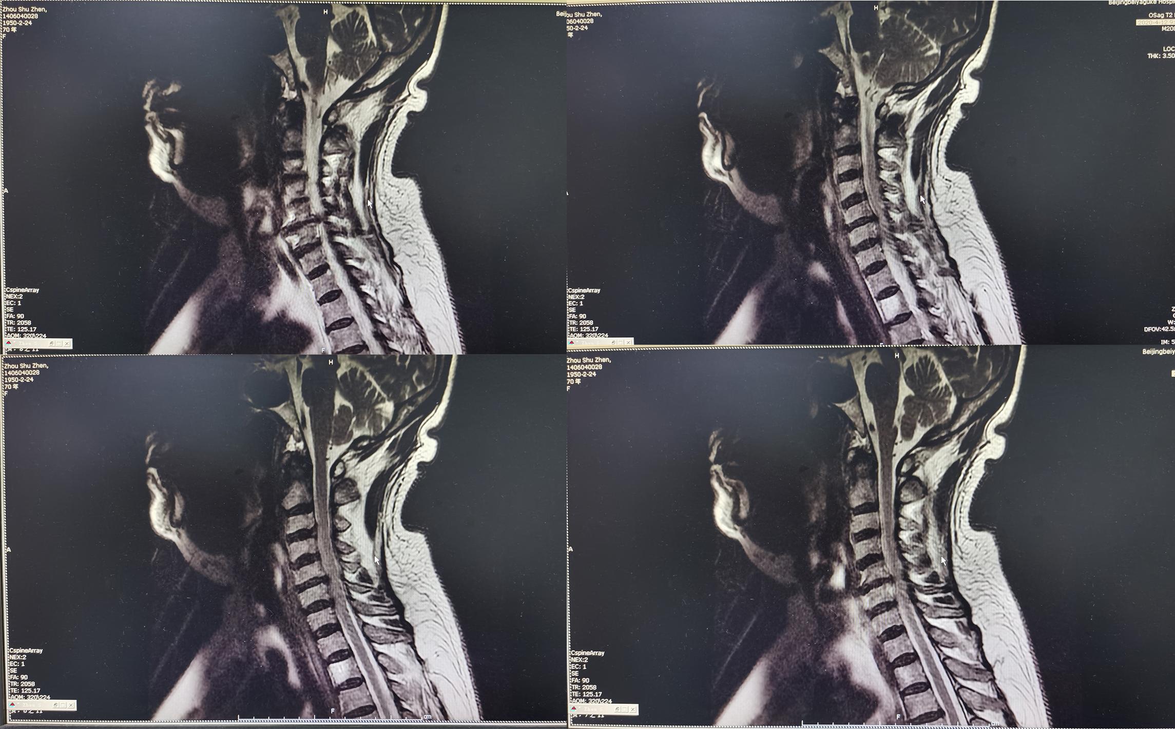 颈椎术后脑脊液漏取什么体位,脊髓型颈椎病手术后植骨愈合时间