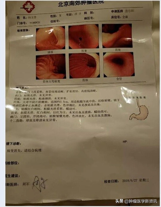 与胃癌做斗争,胃癌的治疗与前沿进展