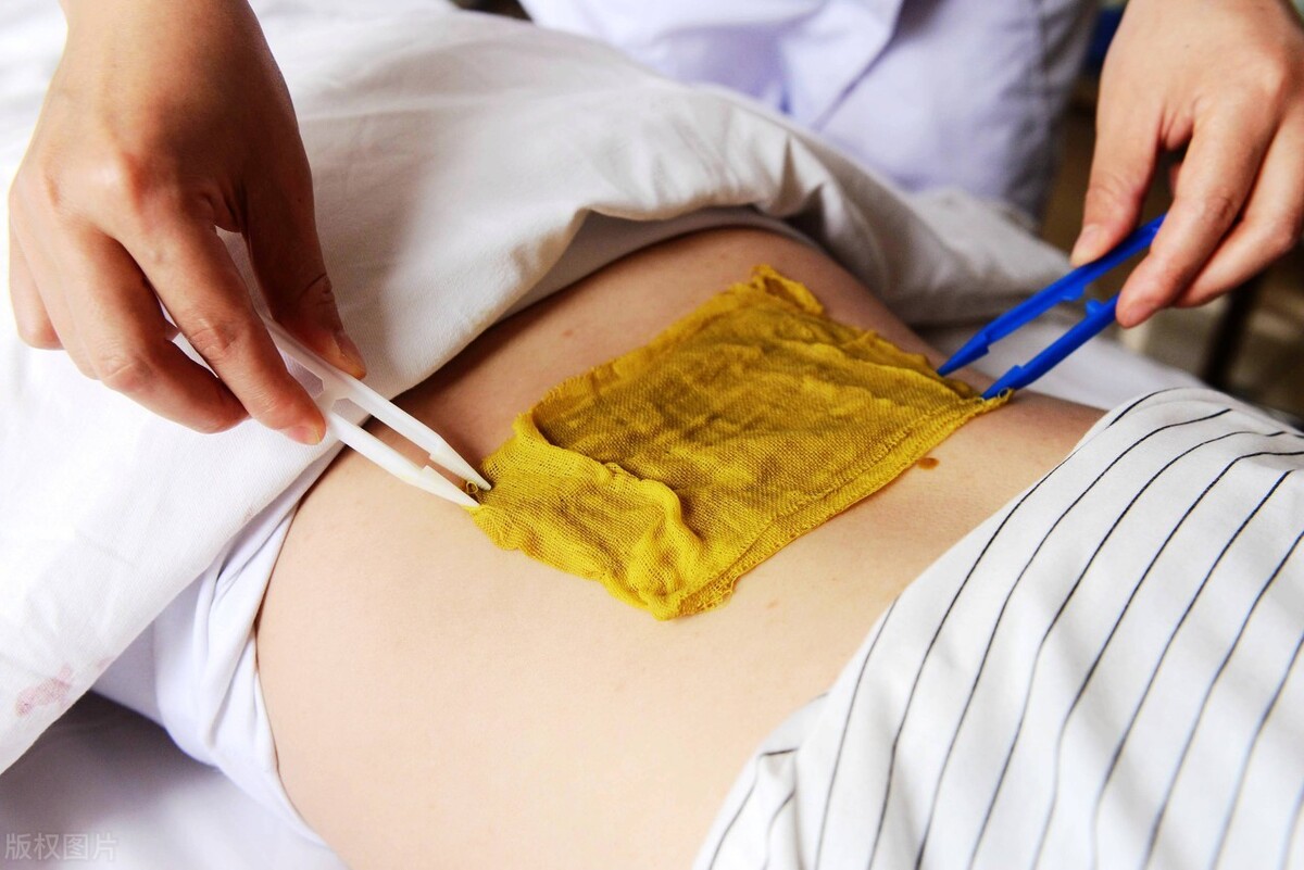 中医治疗消化性溃疡,消化性溃疡药物治疗推荐方案