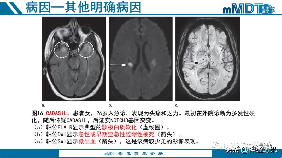 缺血性脑卒中护理课件,缺血性脑卒中讲课ppt