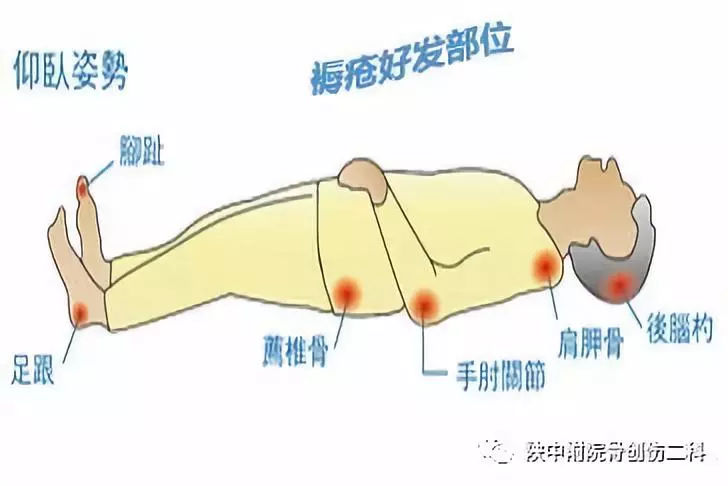 褥疮病人是不是要卧床休养,褥疮需要打消炎针吗