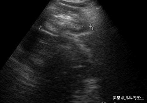 宝宝哭闹不止是肠绞痛还是肠胀气,婴儿每天固定时间哭闹是肠绞痛吗