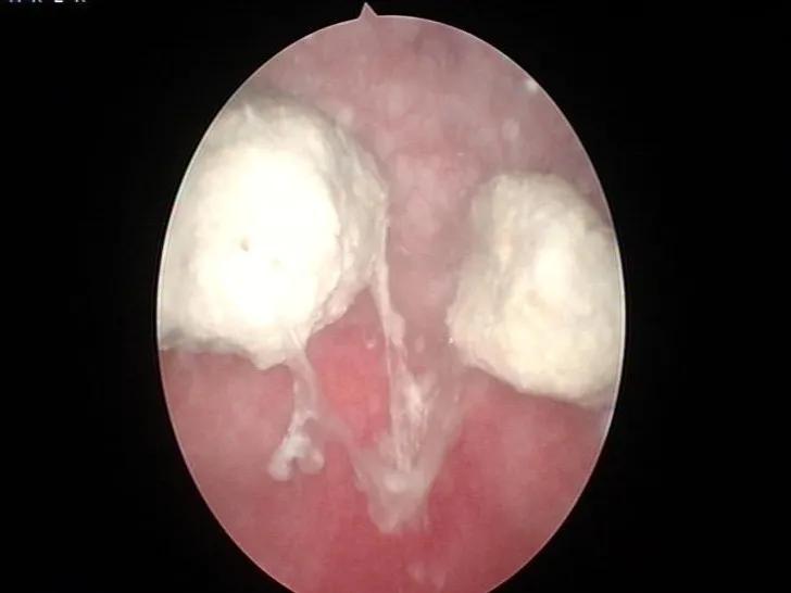 腹腔镜手术取节育环,节育环取出手术