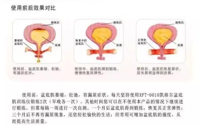 盆底肌没恢复好能训练腹部吗,盆底肌怎么恢复得快