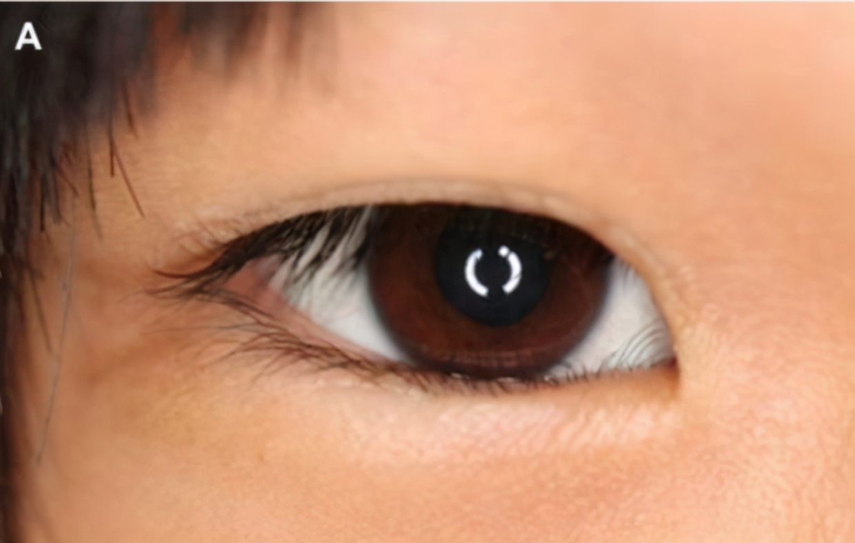 眼睑内翻倒睫治疗方法,老年人倒睫最快的治疗方法