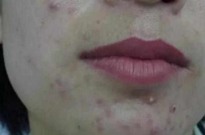 脸上痘痘反反复复怎么办,脸上痘痘反反复复怎么办啊