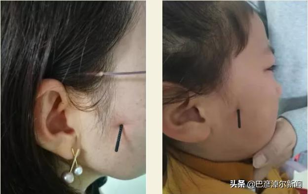 摆脱鼻炎困扰,过敏性鼻炎针刺哪些穴位有效