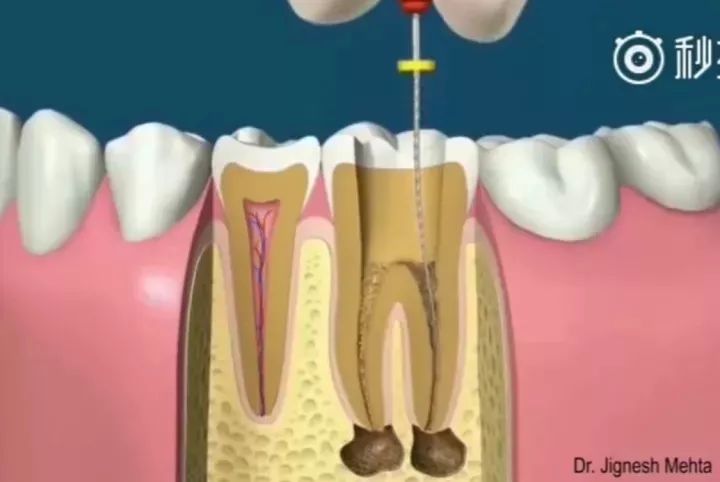 蛀牙了十几年还需要做根管治疗吗,蛀牙了一个小洞要根管治疗吗