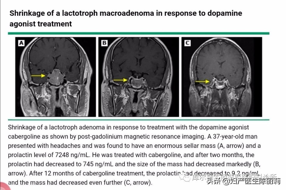 高催乳素血症的临床表现,高催乳素血症的表现正常吗