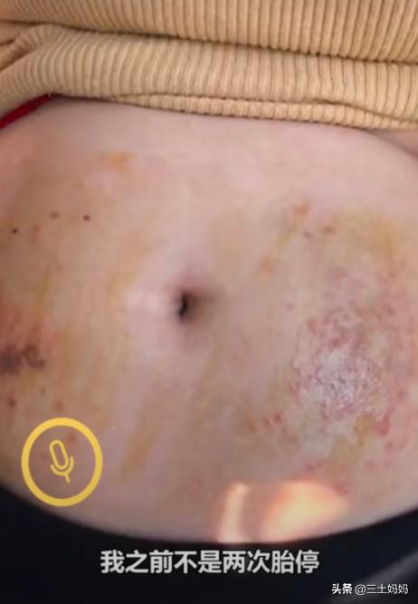 怀孕保胎肚子上打的是什么针,宝妈为保胎打500多针