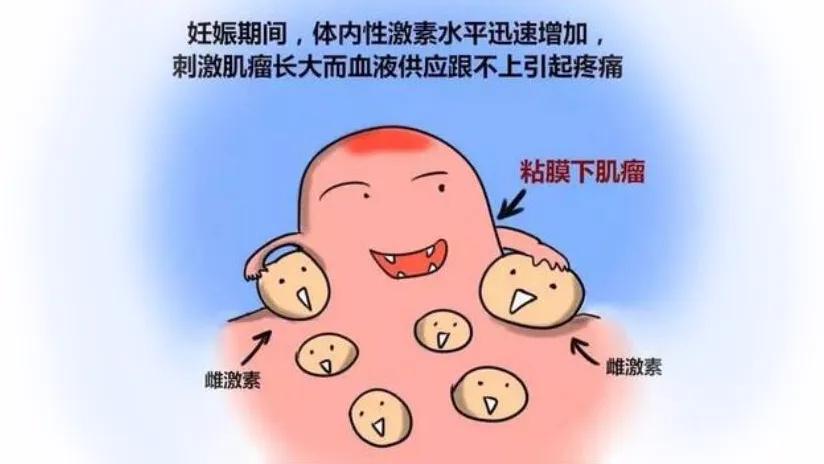 专家讲子宫肌瘤,如果怀孕了发现有子宫肌瘤怎么办