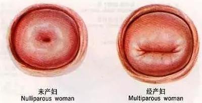 如何判断是否阴道松弛？