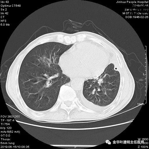 手术引起乳糜胸,有没有做了肺结节手术后是误诊的